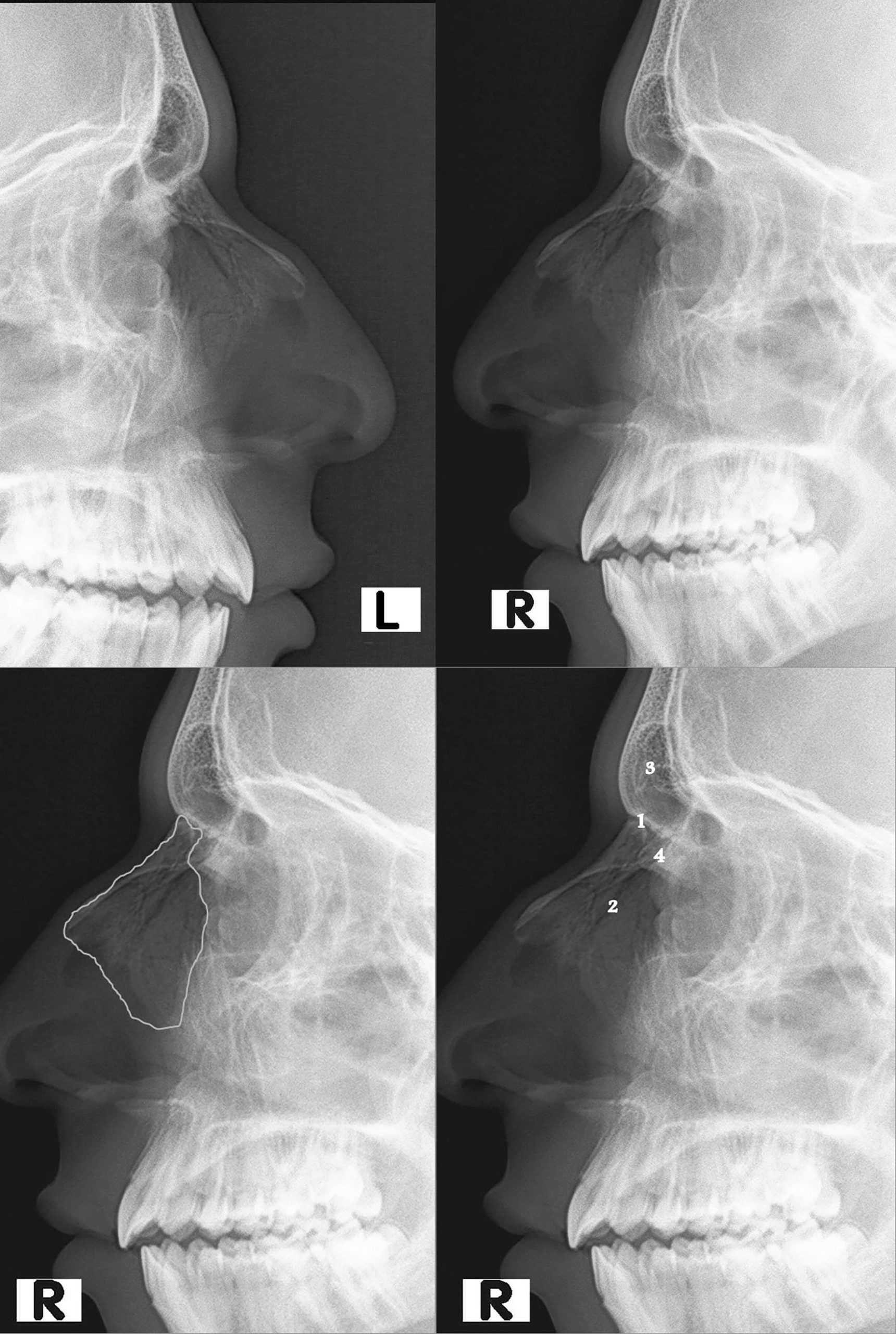 g-y-x-ng-ch-nh-m-i-nasal-bone-fracture-radiology-ch-n-o-n-h-nh-nh